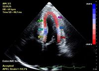 Cardiac Amyloidosis image